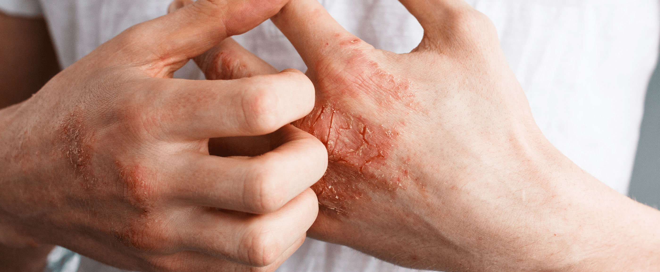 Eczema types symptoms and treatment Eucerin